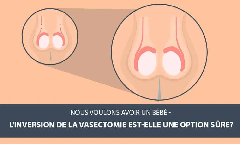 Schéma de l'anatomie de la reproduction masculine avec des informations sur l'inversion de la vasectomie en tant qu'option de fertilité sûre.